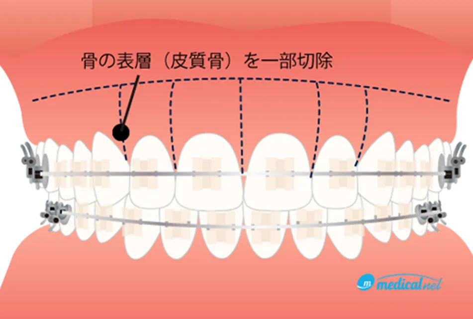 期間の短縮を図れる矯正治療